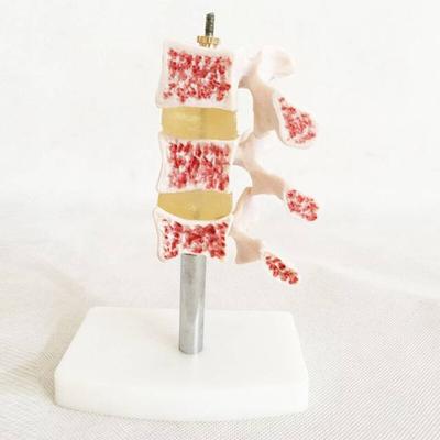 Cutaway Osteoporosis Medical Model